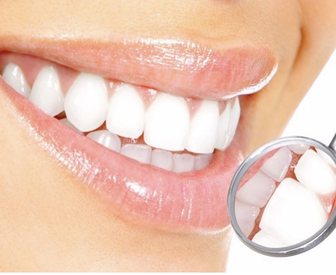 CLAREAMENTO DENTAL A LASER E CASEIRO